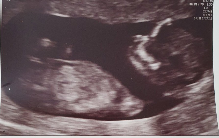 upclose pregnancy scan